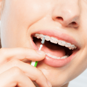 How to care for braces - some tips 2 Woman cleaning her braces, representing how to care for braces