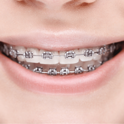 Dental Braces - an overview