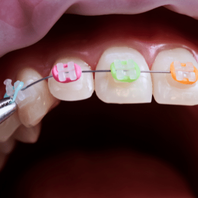 https://smilesortho.com/wp-content/uploads/2020/02/colored-rubber-bands.png