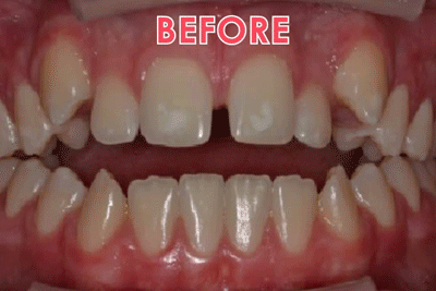 Before & after smiles