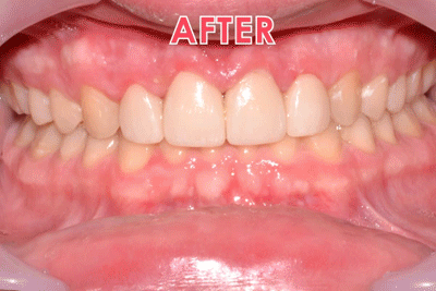 Before & after smiles