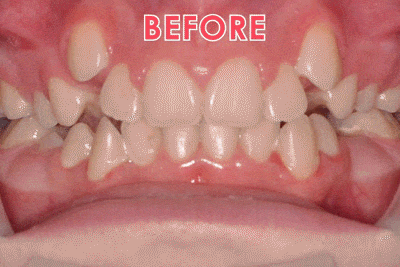 Before & after smiles