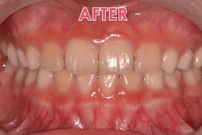 Mina phase1-1 Mina smiles orthodontics before and after