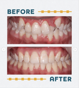 Orthodontic smile transformation: crowded teeth treatment in wichita ks 4 Before and after photo of the patient's teeth