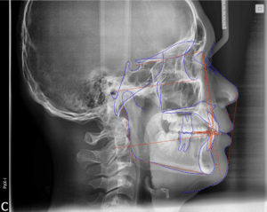 Orthodontic smile transformation: crowded teeth treatment in wichita ks 3 X-ray of the patient's teeth