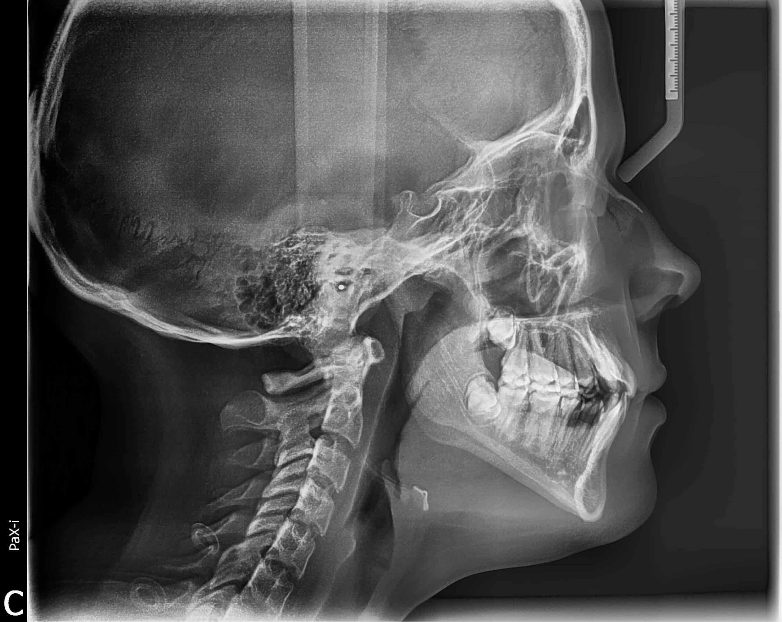 Pretreat ceph Pretreatment cephalometric x-ray used for orthodontic diagnosis and treatment planning at smiles orthodontics in wichita and andover, kansas