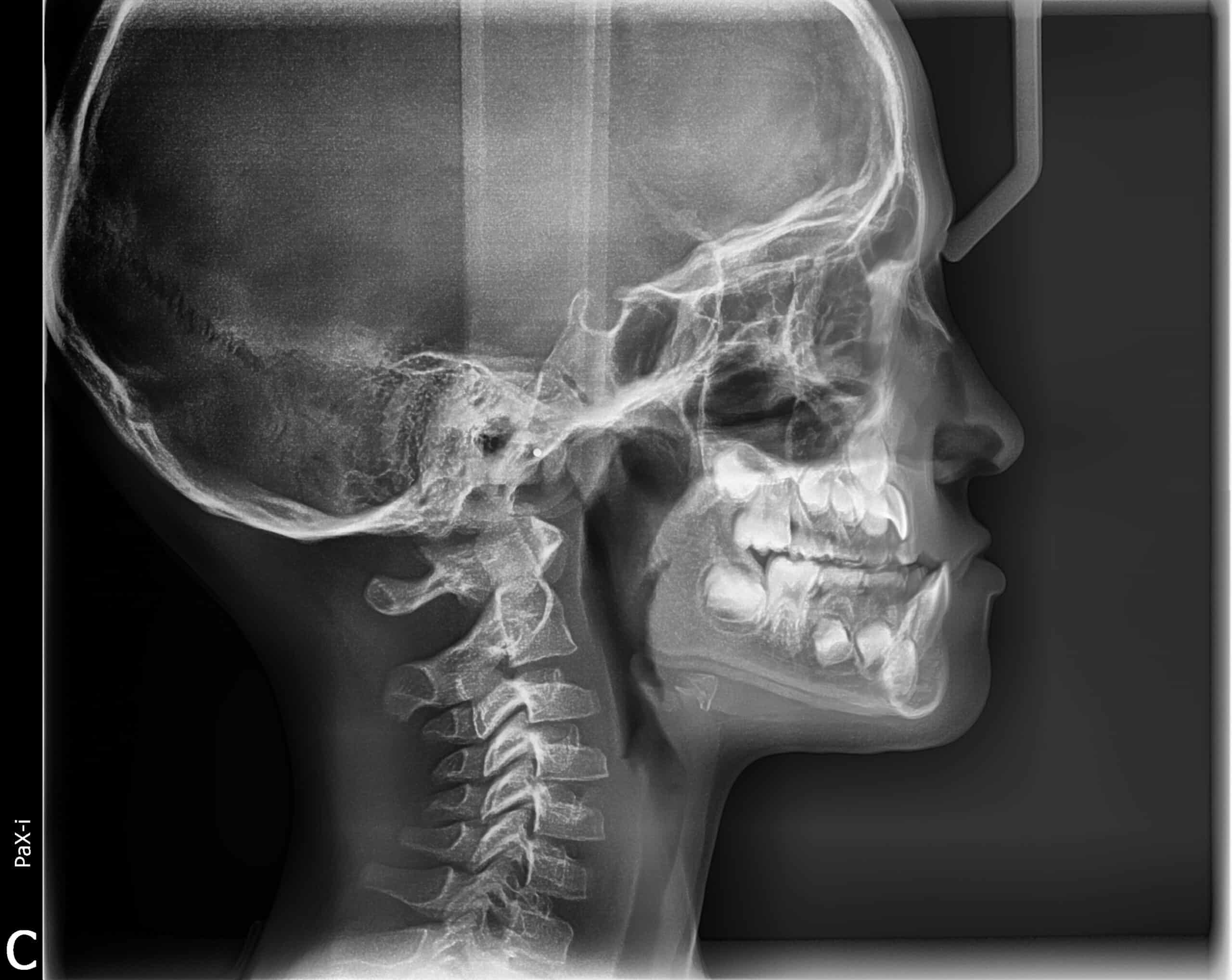 Pretreatment ceps X-ray showing a patient's severe underbite before treatment at smiles orthodontics