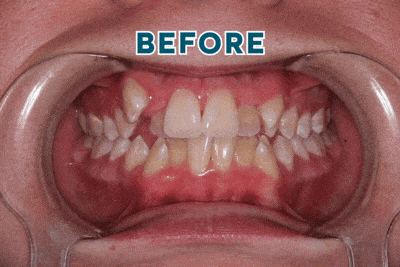 Smiles-experience-before-and-after-gif-girl Before orthodontic treatment showing crowded and misaligned teeth at smiles orthodontics in wichita and andover, kansas