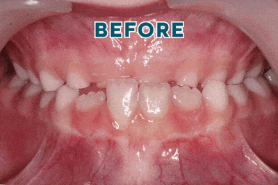 Smiles-experience-before-and-after-gif Before and after gif showcasing smiles orthodontics' work on a patient with an overbite.