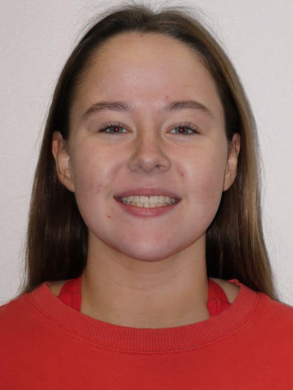 Before and after smiles 5 Teen patient after orthodontic treatment with straighter smile at smiles orthodontics in wichita and andover, kansas