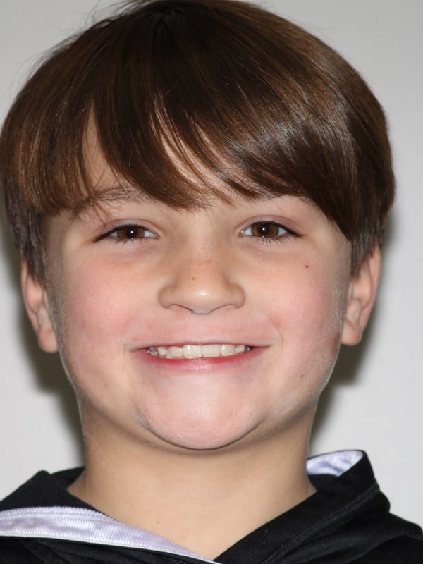 Before and after smiles 3 Smiles orthodontics patient smiling after treatment.