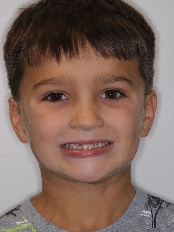 Before and after smiles 2 Smiles orthodontics patient smiling before treatment.